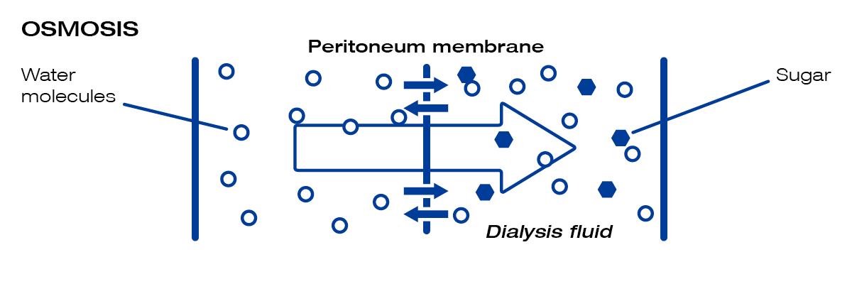 How excess water is removed from the body in dialysis