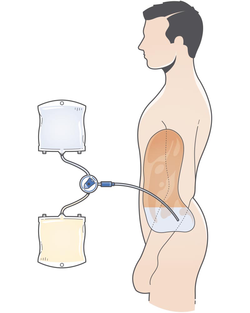 Diálisis peritoneal
