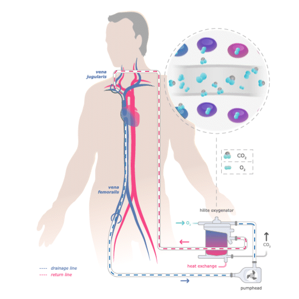 03_VV-ECMO-adult-femoro-jugular_1x1_01
