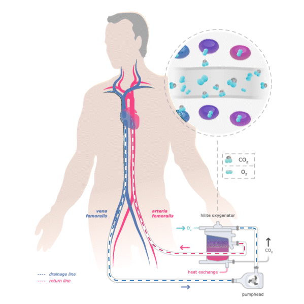 03_VV-ECMO-adult-femoro-jugular_1x1_01