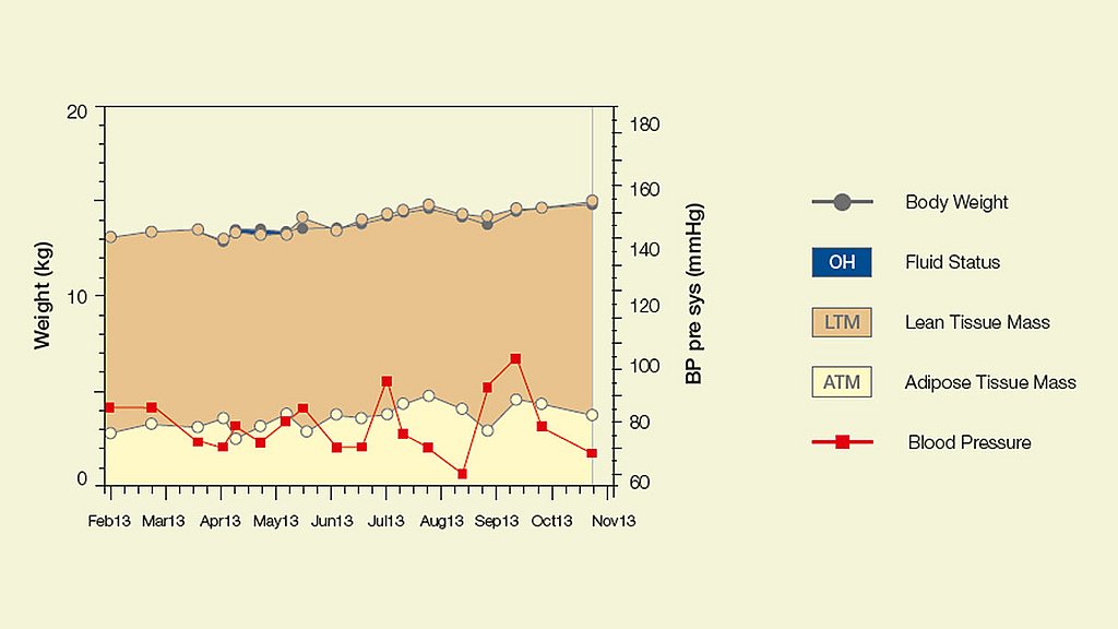 Children dialyzed with biocompatible PD fluids grow better than those on conventional PD fluids3.