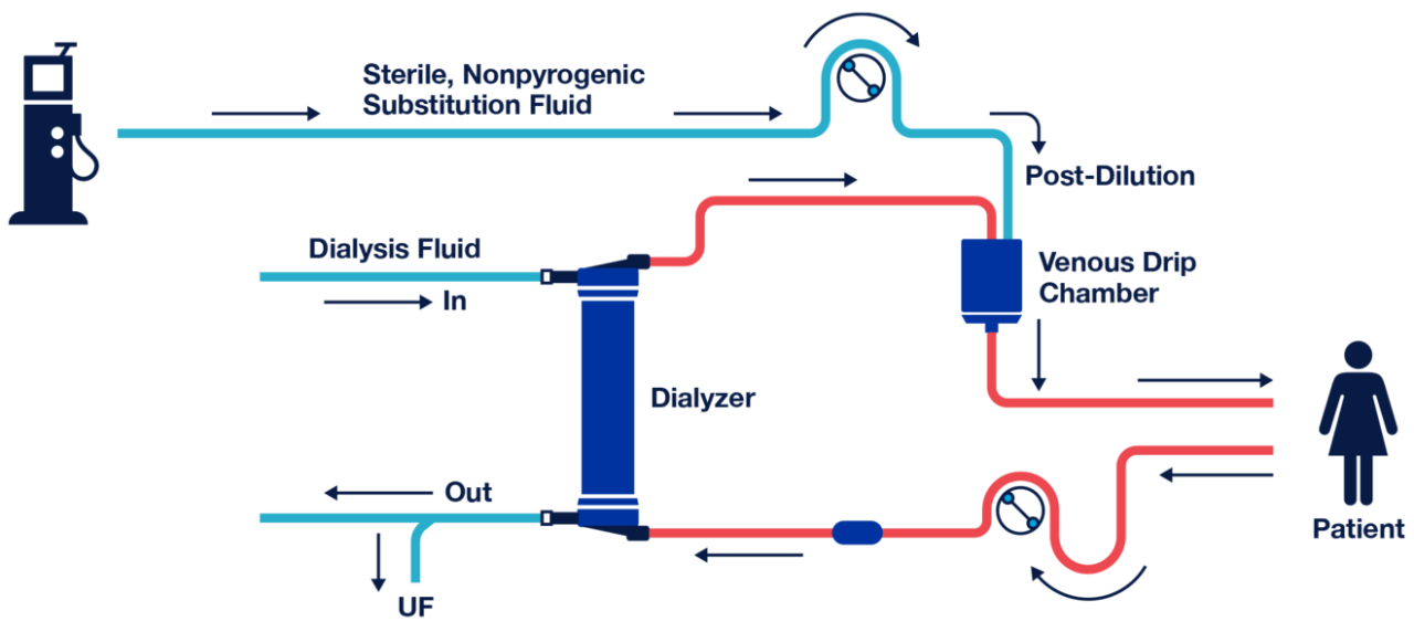 post-dilution_online_hemodiafiltration