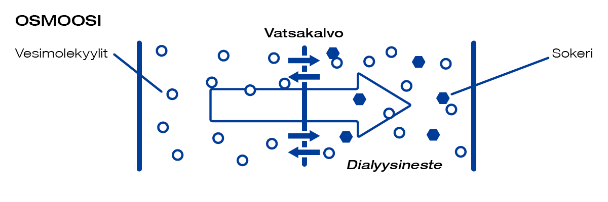 Miten dialyysi poistaa elimistöstä ylimääräisen nesteen