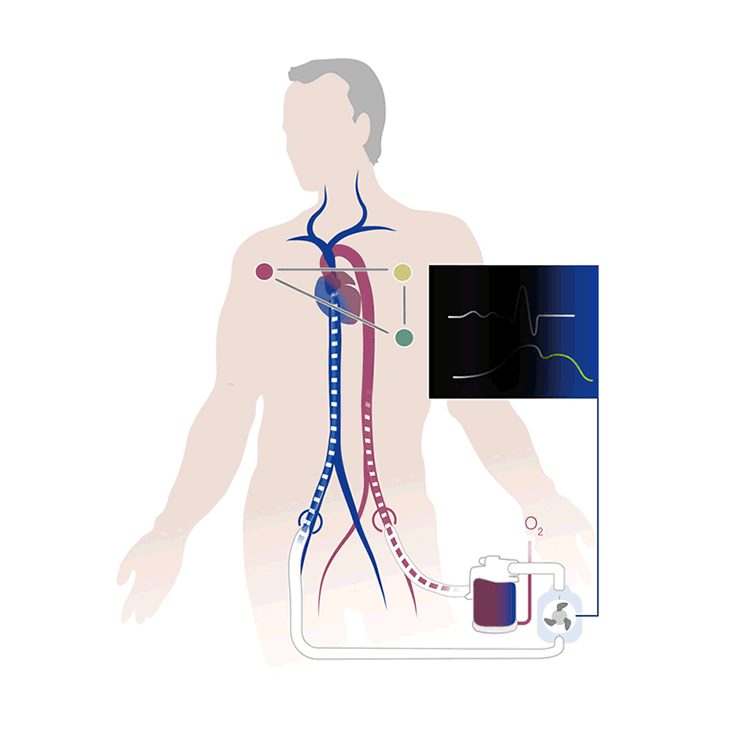 VA ECMO adult with synchronized cardiac support