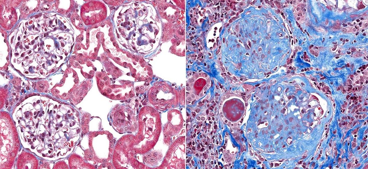 Kidney biopsy