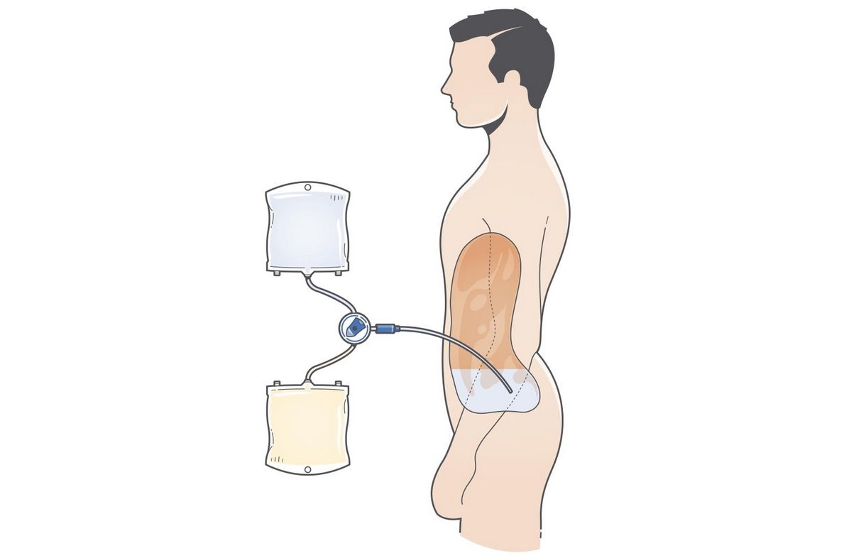 Para quem é que a diálise peritoneal é a melhor opção?